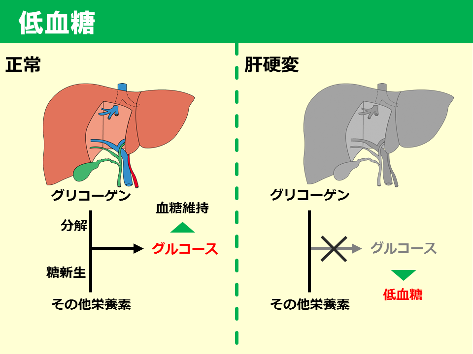 【臨床】肝硬変 SGSブログ